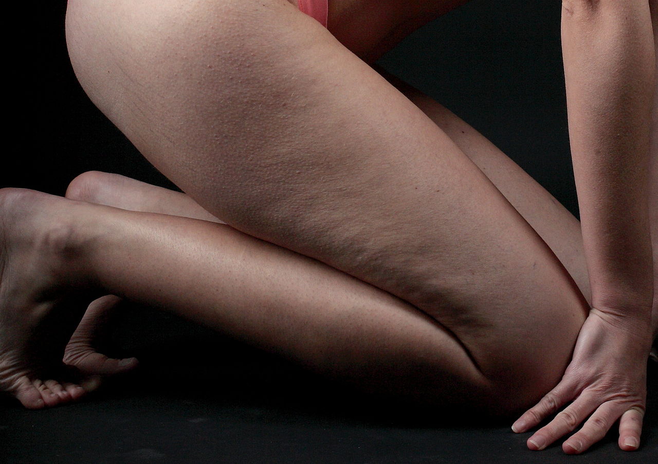 Cellulite-PanciaLeggera