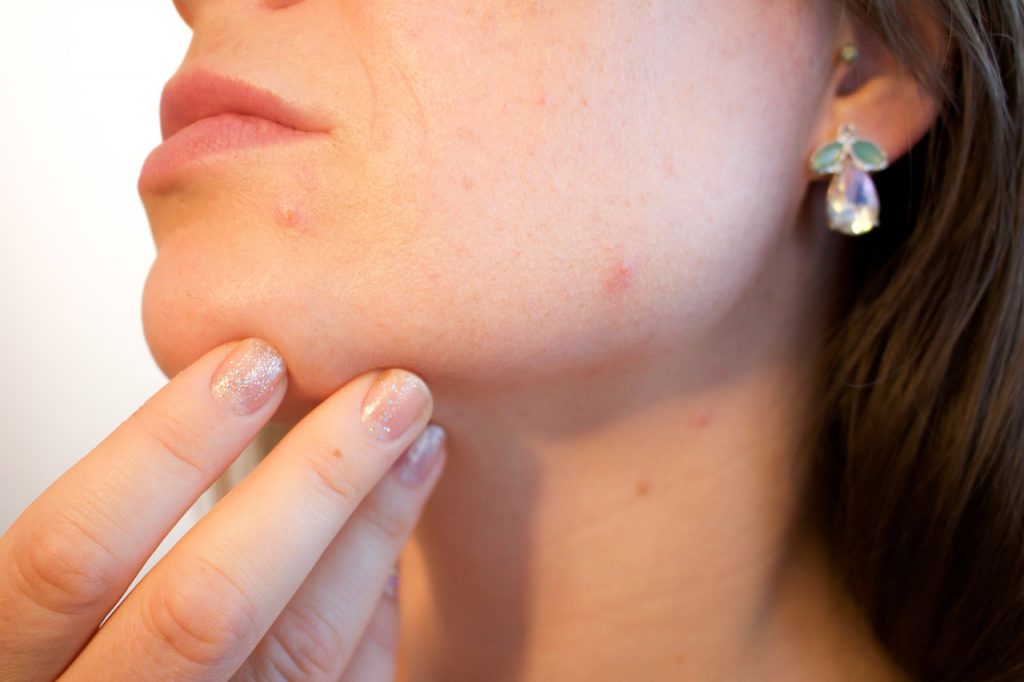 viso-acne-pancialeggera