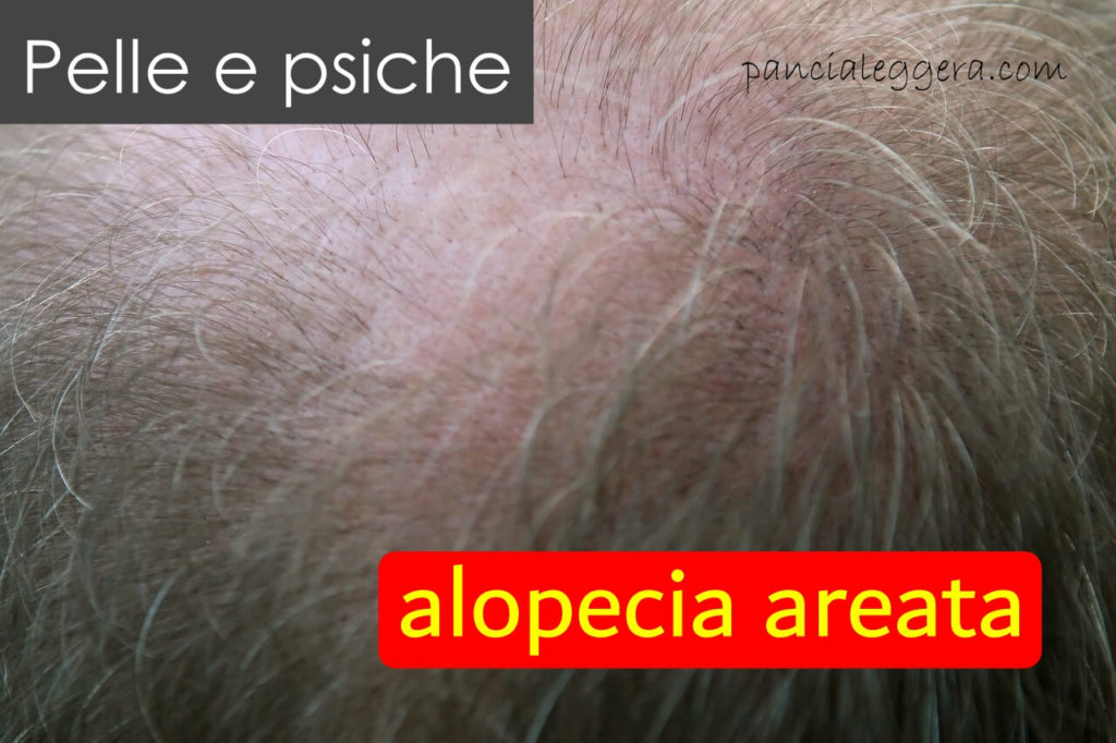 pelle e psiche alopecia areata